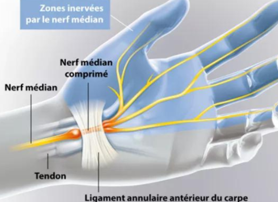 Le tunnel carpien est formé d’une bande élastique, un tendon, qui maintient en place les nerfs et les muscles au niveau de l’intérieur du poignet.